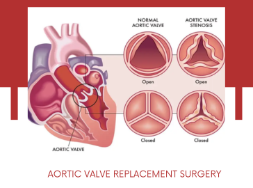 aortic-valve-replacement-surgery