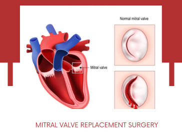 mitral-valve-replacement-surgery-mvr-in-pune