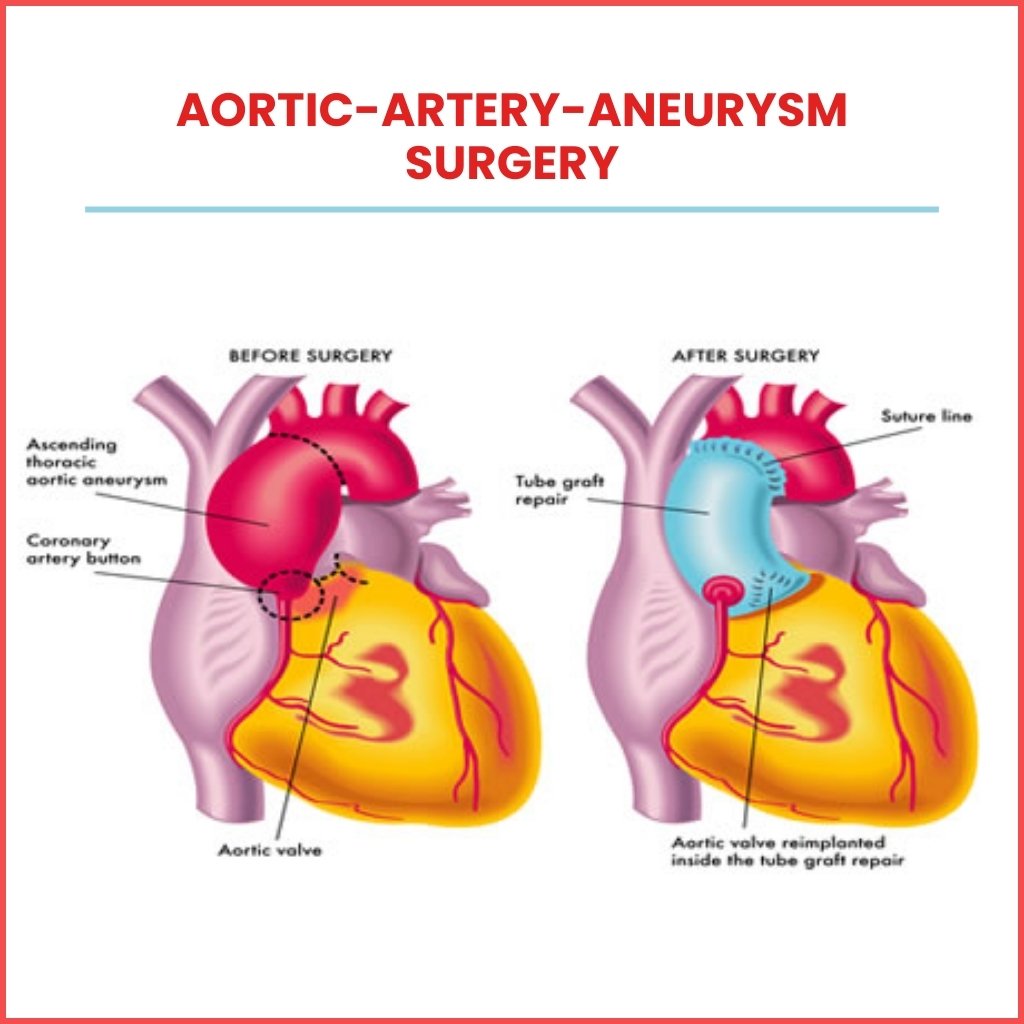 aortic-artery-aneurysm-surgery