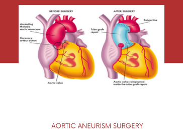 aortic-artery-aneurysm-surgery-in-pune