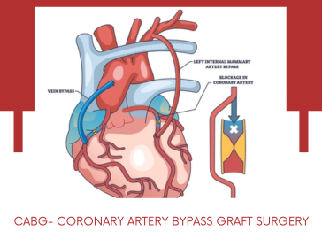 coronary-artery-bypass-graft-surgery-graft-in-pune